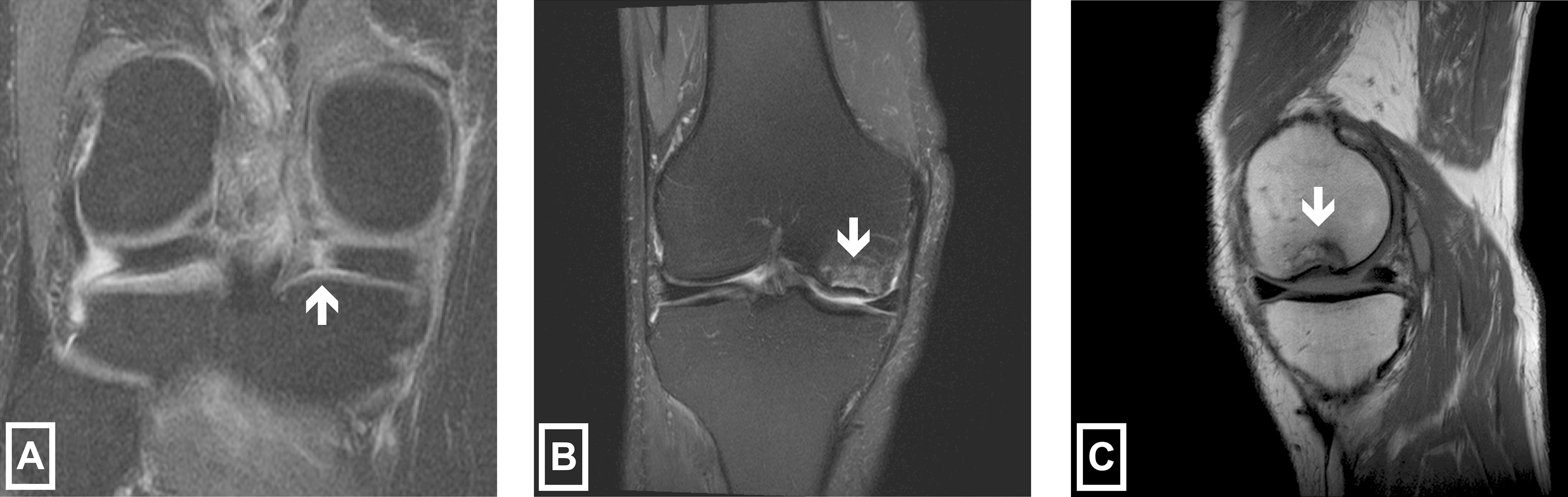 JBJS: Spontaneous Osteonecrosis/Subchondral Insufficiency Fractures of ...